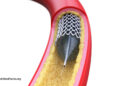 Why Aren’t Angioplasty Coronary heart Stents Extra Efficient? 