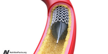 Why Aren’t Angioplasty Coronary heart Stents Extra Efficient? 