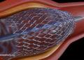 Coronary heart Stents and Their Dangers 