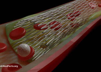 Do Coronary heart Stents Profit Angina Chest Ache? 