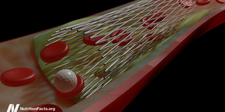 Do Coronary heart Stents Profit Angina Chest Ache?