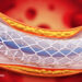Why Use Stents When They Don’t Work?