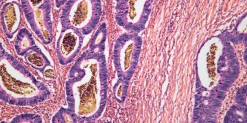 A New Immune Remedy Might Work In opposition to A number of Most cancers Sorts