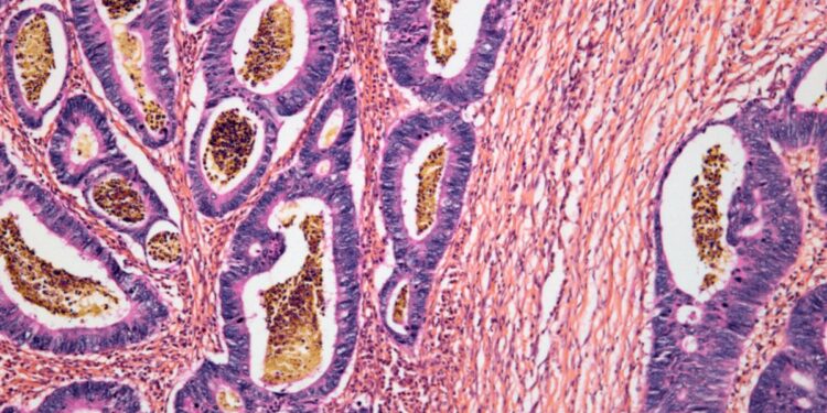 A New Immune Remedy Might Work In opposition to A number of Most cancers Sorts