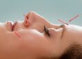 Is Facial Acupuncture the New Botox?
