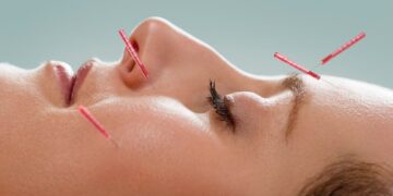Is Facial Acupuncture the New Botox?