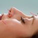 Is Facial Acupuncture the New Botox?