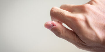 Pores and skin-picking as self-soothing: is emotion regulation the lacking piece?