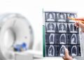 Consultants Need Extra Folks Screened for Lung Most cancers