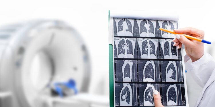 Consultants Need Extra Folks Screened for Lung Most cancers