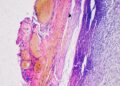 A Customized Most cancers Vaccine Lowers Melanoma Recurrence by 42%