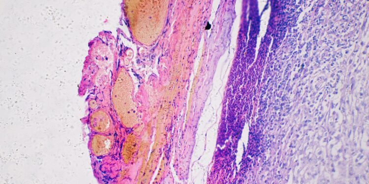 A Customized Most cancers Vaccine Lowers Melanoma Recurrence by 42%