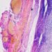 A Customized Most cancers Vaccine Lowers Melanoma Recurrence by 42%